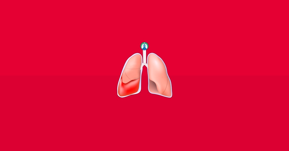 Hemothorax Overview and Practice Questions