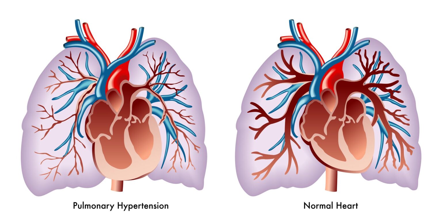 Inhaled Pulmonary Vasodilators An Overview (2023)