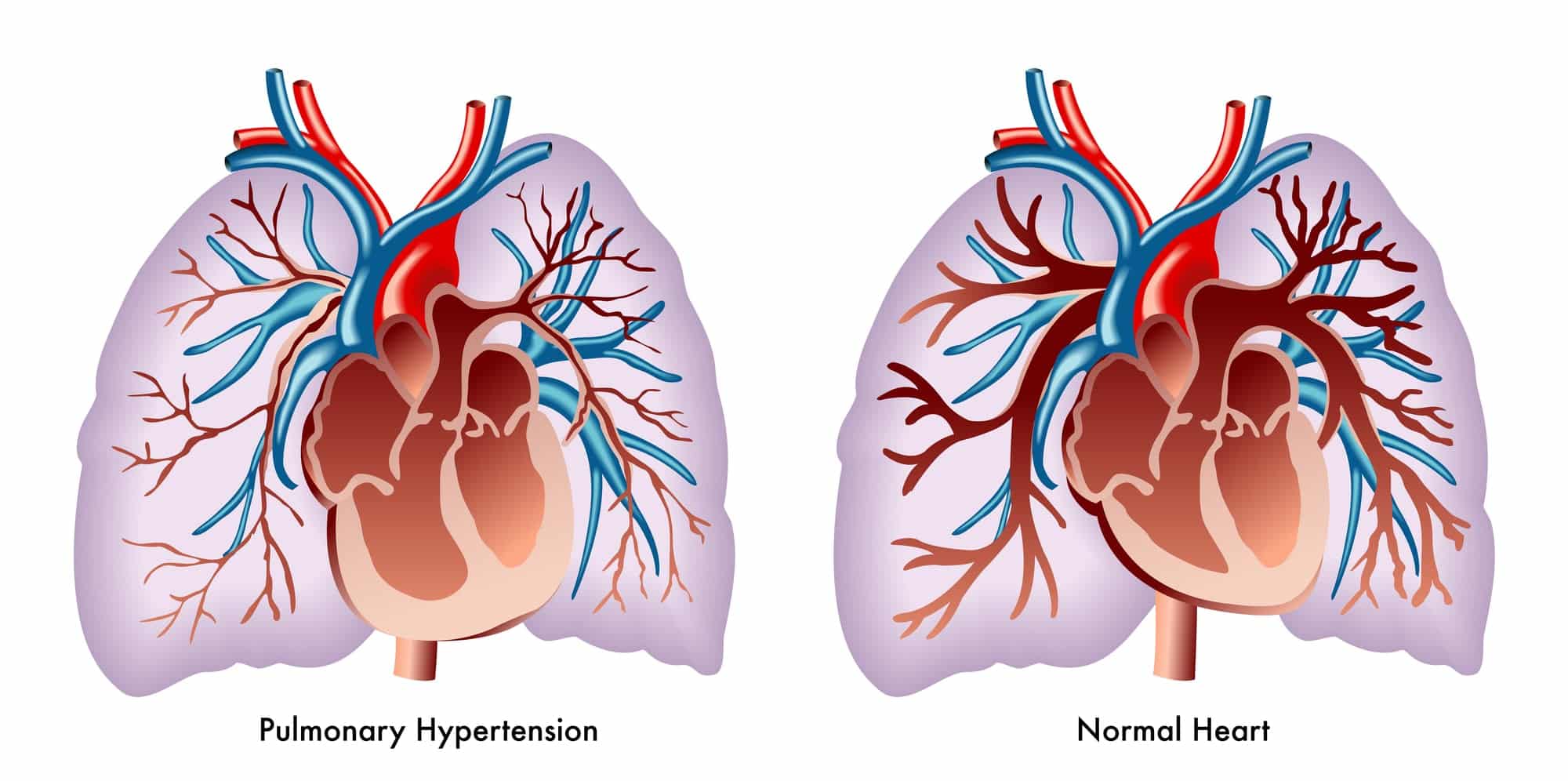 Inhaled Pulmonary Vasodilators An Overview (2024)