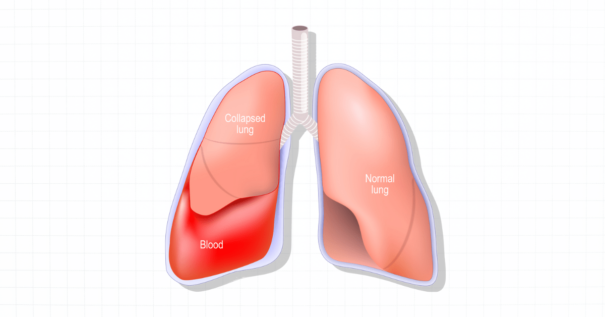 Hemothorax Vector Illustration