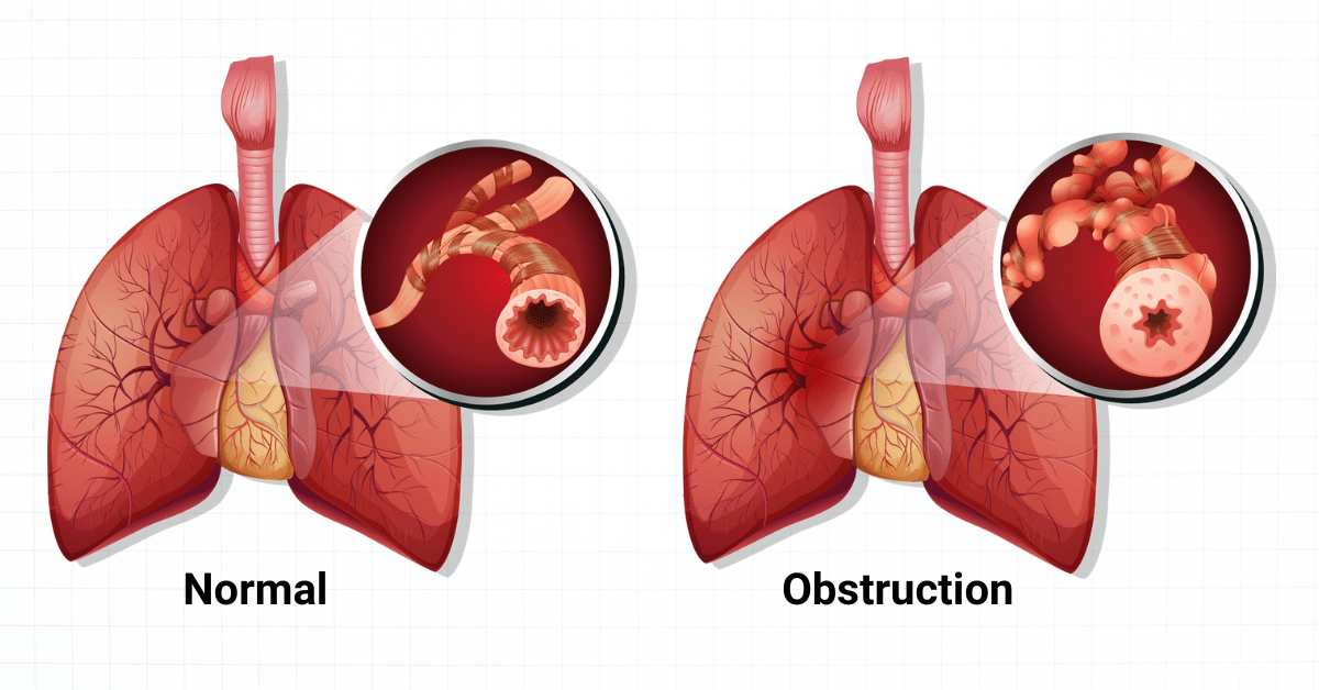 Airway Resistance Respiratory Disease UPFV Airway Resistance Respiratory Disease UPFV