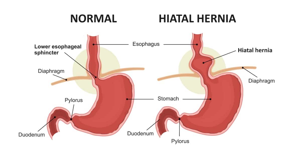 Hiatus Hernia Labeled Illustration