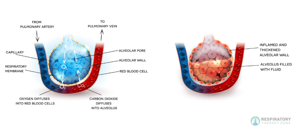 pulmonary-edema-vs-pneumonia-an-overview-2023
