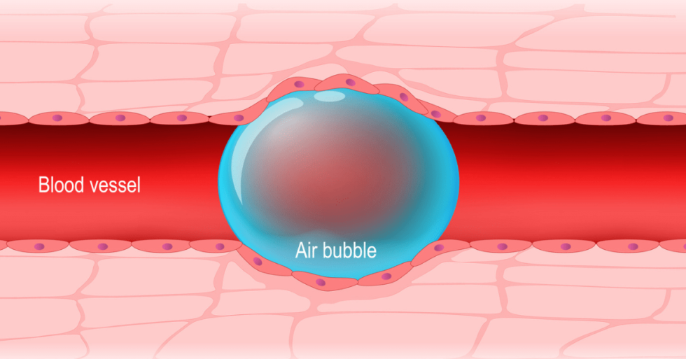 How Long for an Air Embolism to Kill You? (2024)