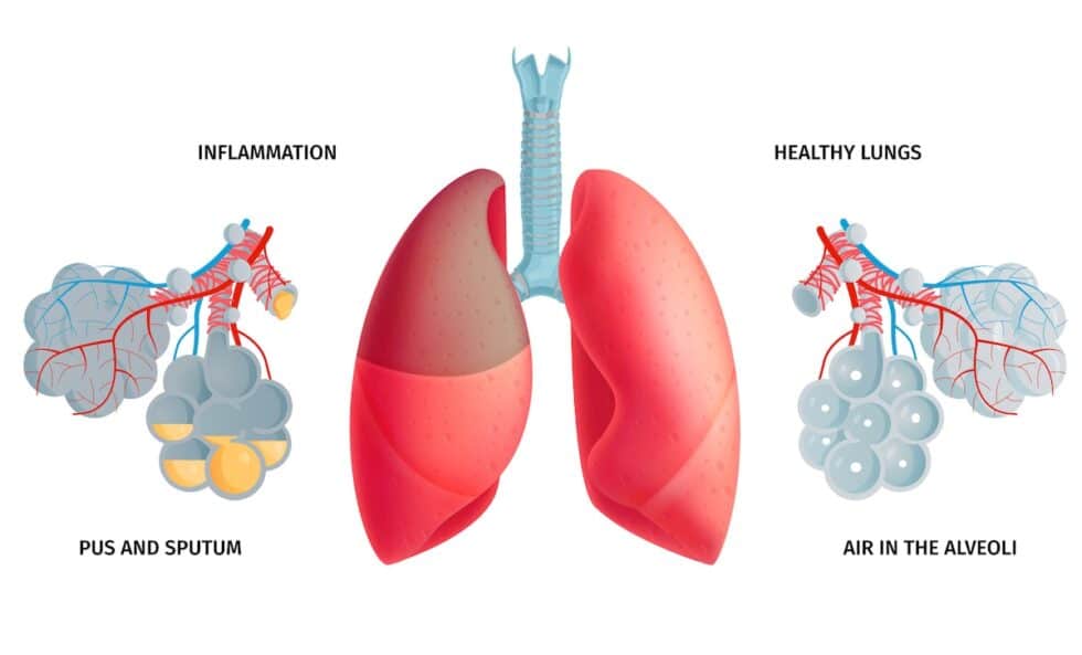 Can a Humidifier Cause Pneumonia? (2023)