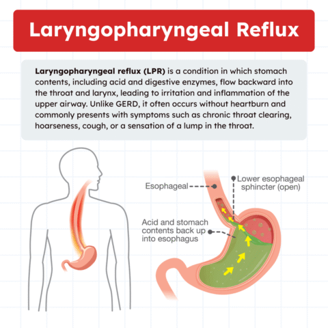 Laryngopharyngeal Reflux: Causes, Symptoms, and Treatment