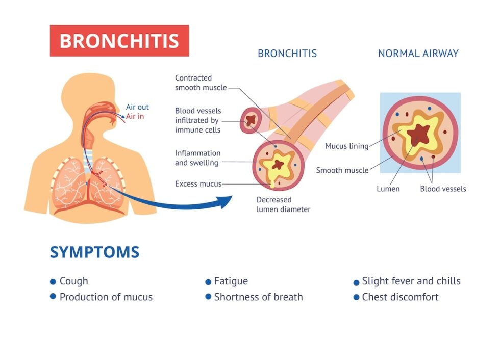 Bronchitis Causes, Symptoms, and Treatment (2024)