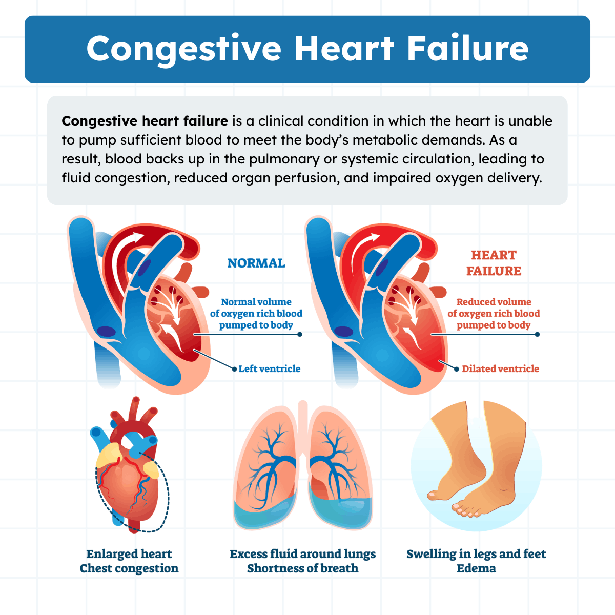 Congestive Heart Failure (CHF) in Respiratory Care (2026)