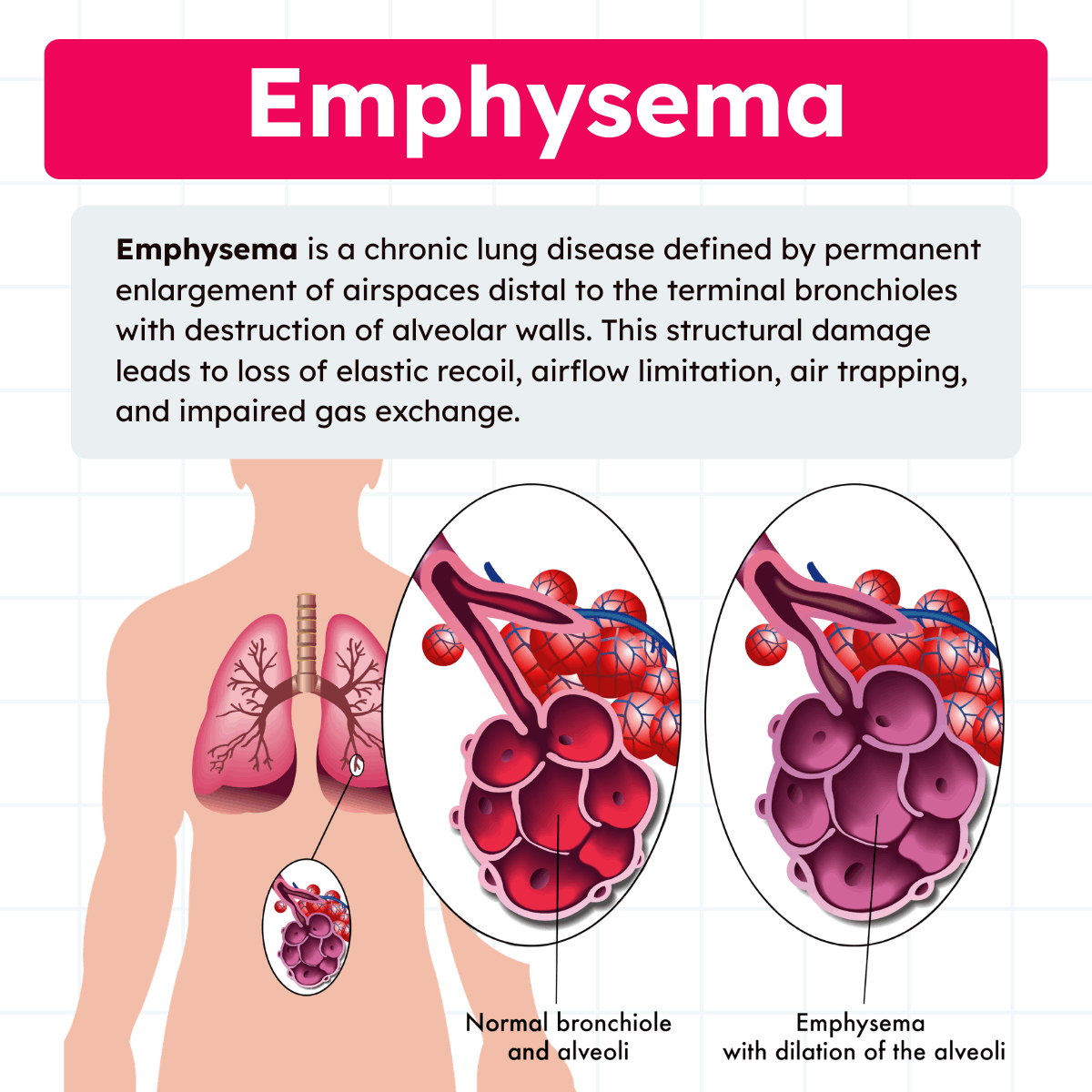 Emphysema Patient Info