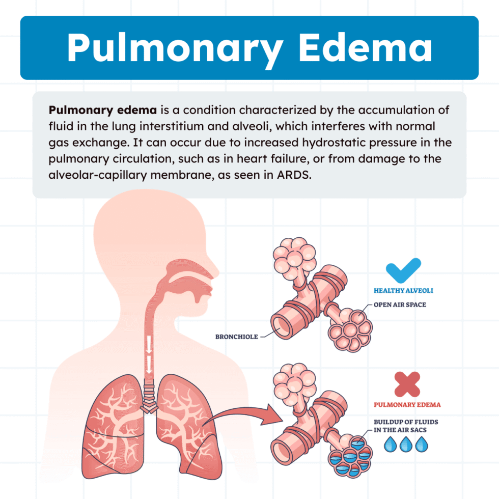 Pulmonary Edema: Causes and Clinical Management (2026)
