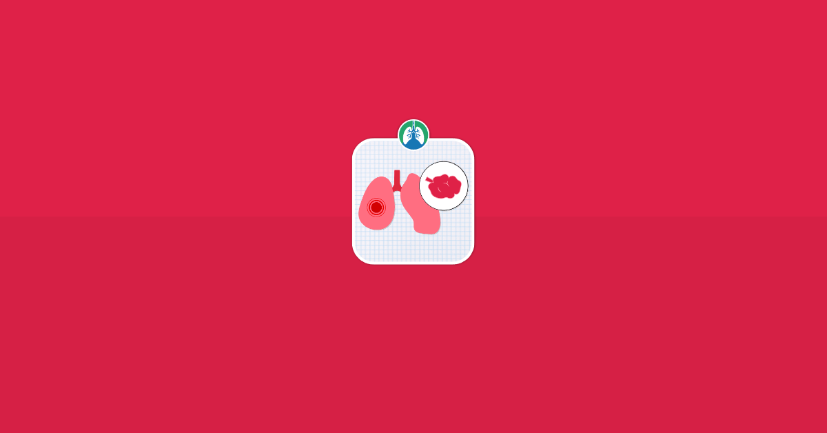 Atelectasis Lungs Alveoli Vector