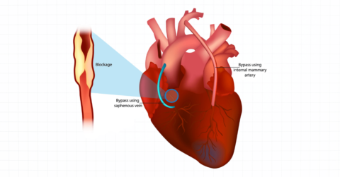 Vector Cabg Ventilator Weaning After Coronary Artery Bypass Graft (CABG)