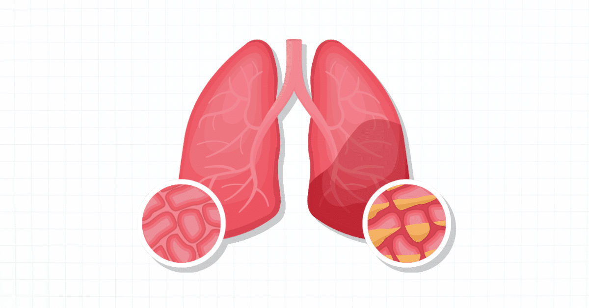 Pneumonia lungs vector illustration