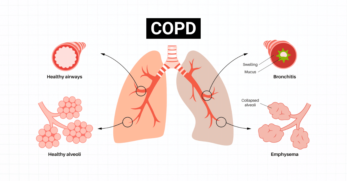 COPD Lungs Labeled Vector Illustration