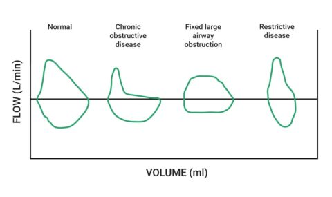 5+ Pulmonary Function Testing (PFT) Tips for the TMC Exam