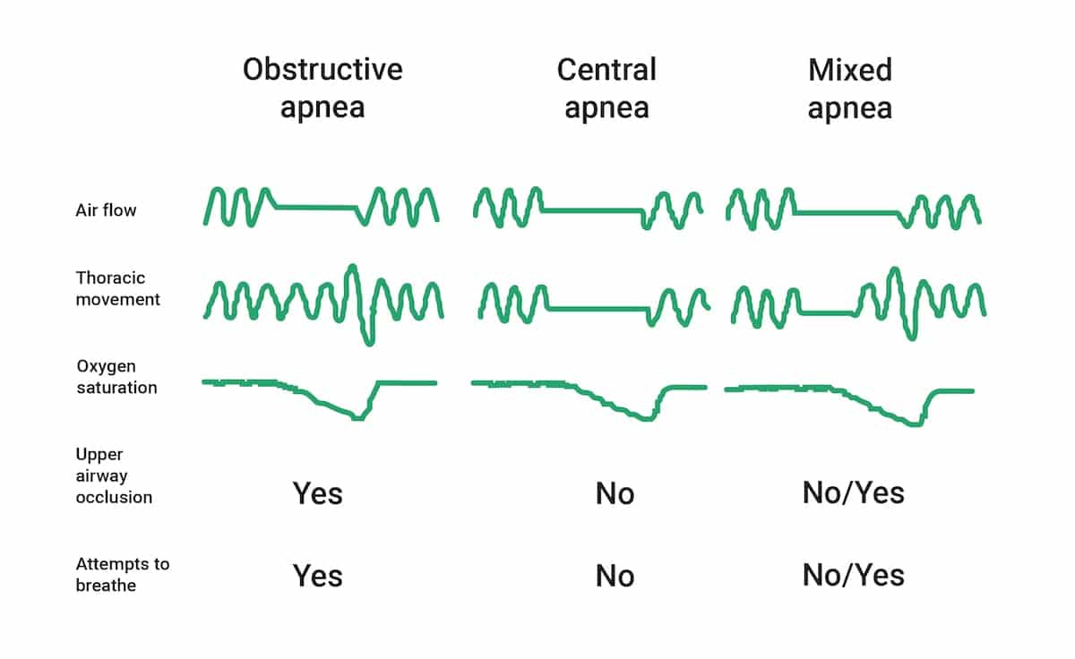Sleep Apnea Types Patterns Obstructive vs. Central Illustration