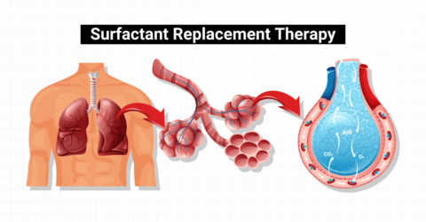 Surfactant Replacement Therapy: Overview and Practice Questions