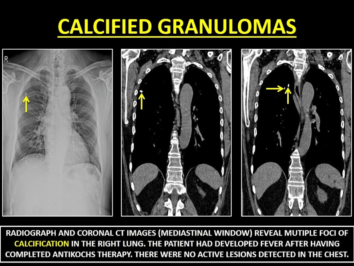 Calcified granuloma in the lungs x-ray illustration