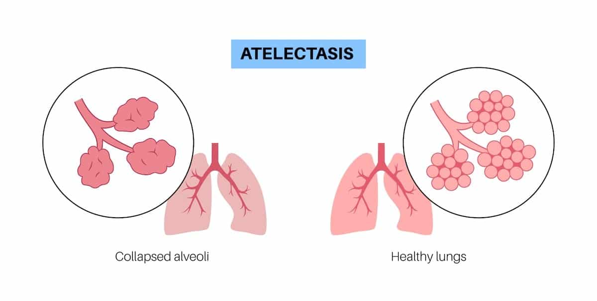 Atelectasis vector illustration graphic