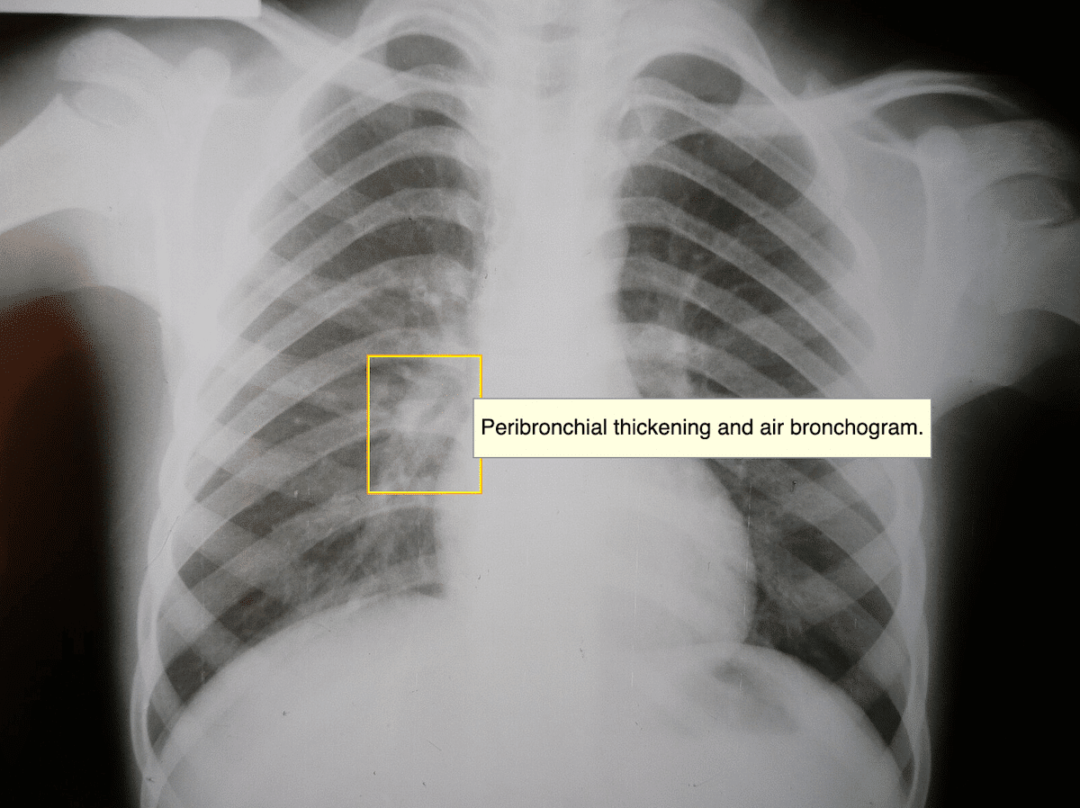 Air Bronchogram Key Imaging Sign Of Lung Disease 2026 