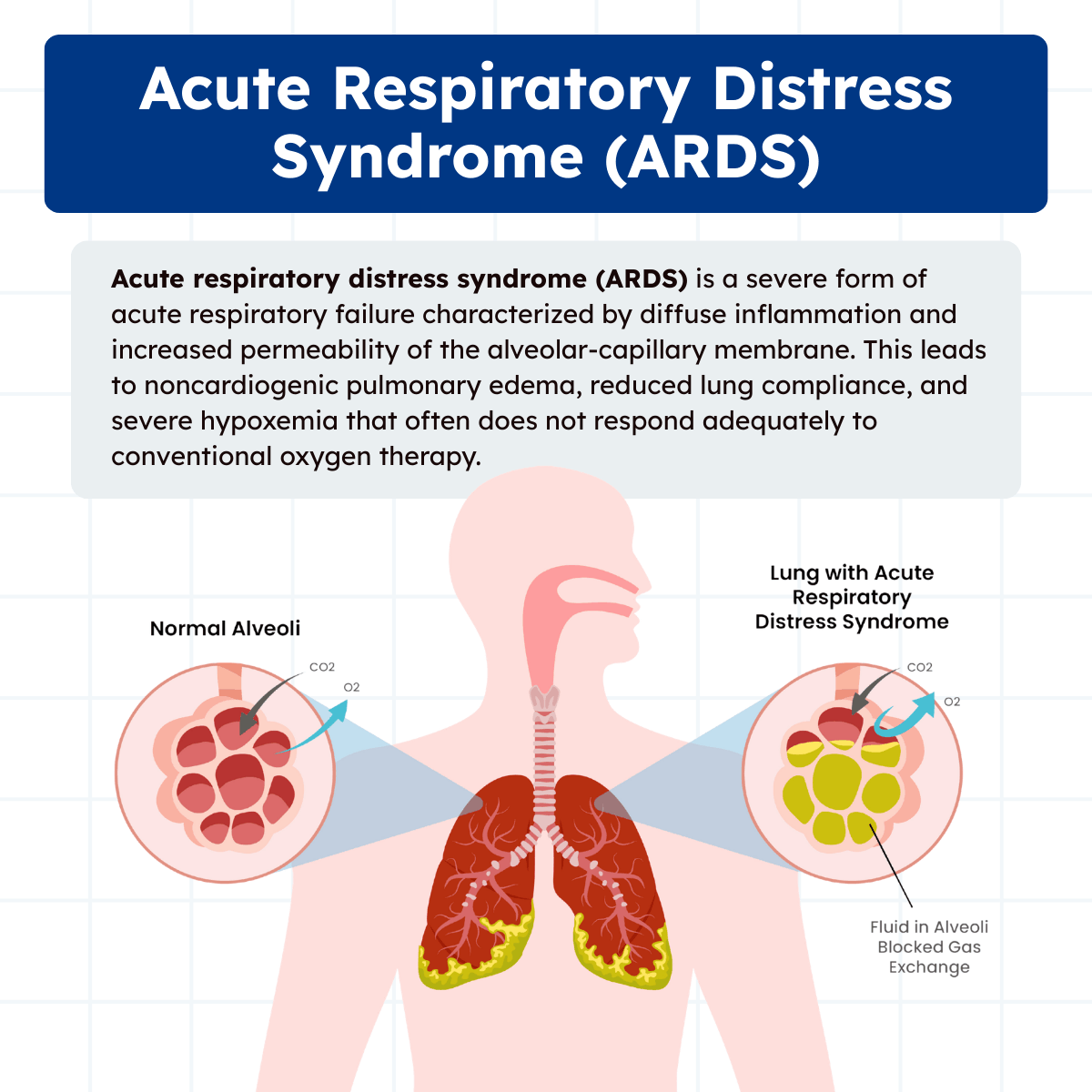Acute Respiratory Distress Syndrome Nice