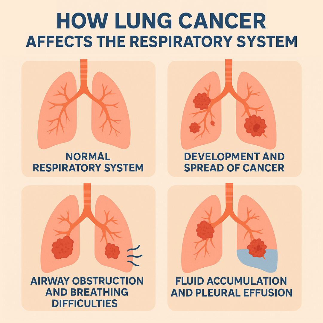 How Does Lung Cancer Affect the Respiratory System Illustration Infographic