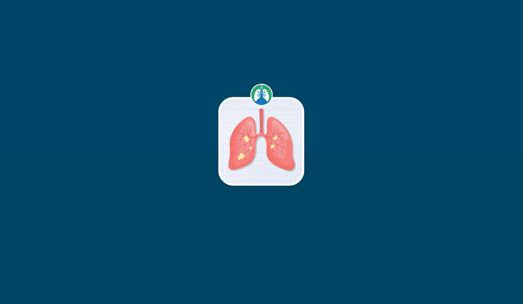 Sarcoidosis: Overview and Practice Questions (2025)