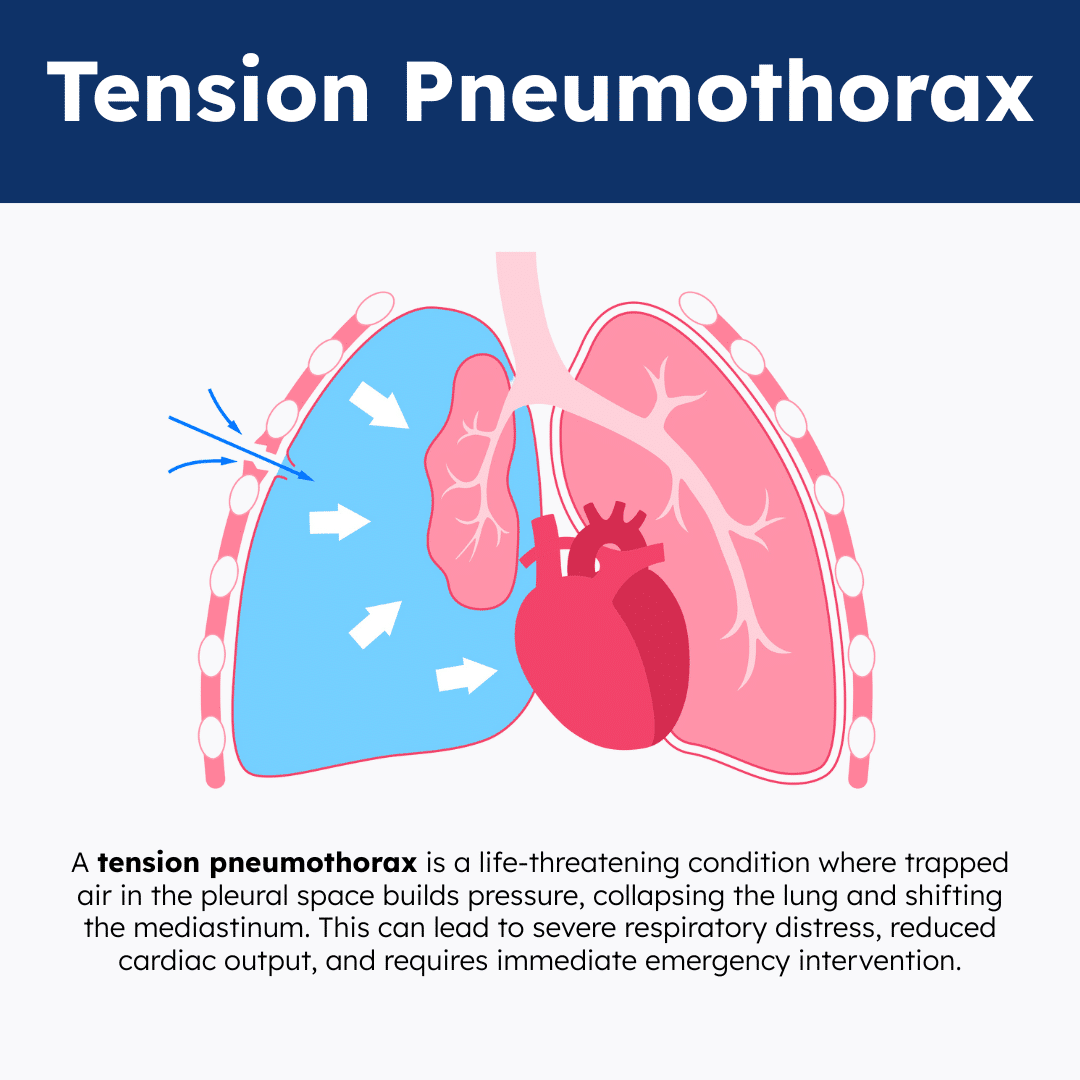 Tension Pneumothorax Illustration Infographic