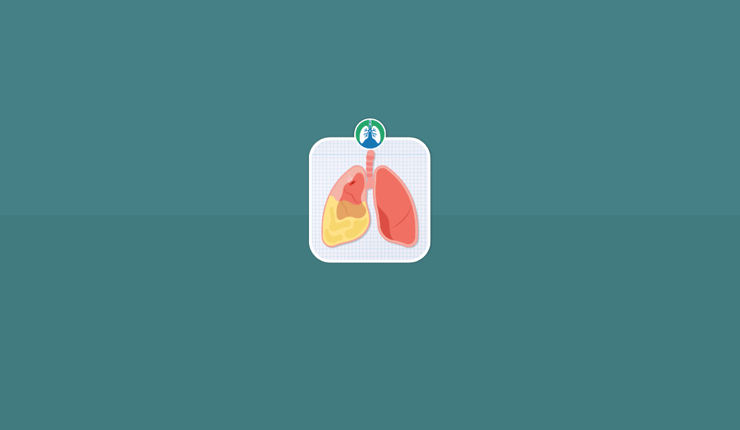 How Long Does it Take to Drain Fluid From the Lungs? (2025)