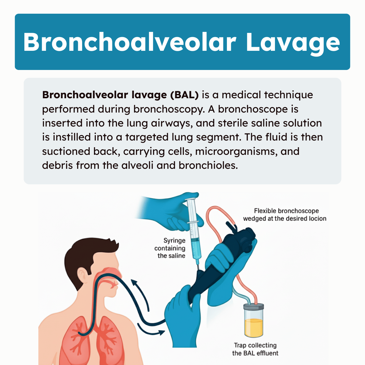 Bronchoalveolar Lavage Illustration Infographic