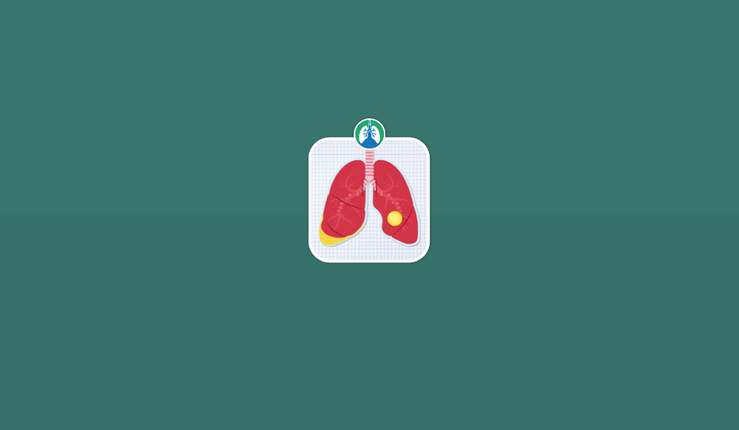 Empyema vs. Lung Abscess: What’s the Difference? (2025)