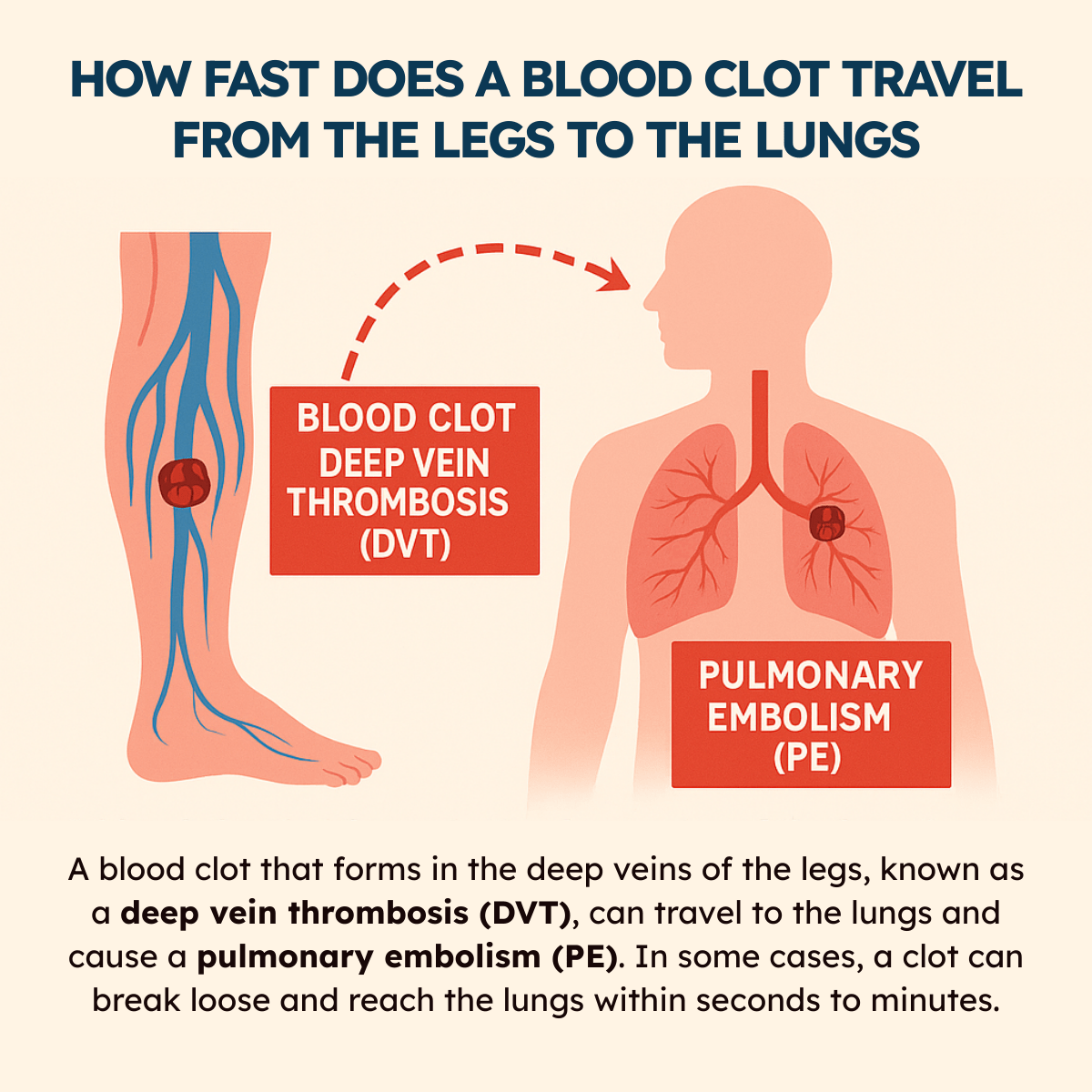 How Fast Does a Blood Clot Travel from the Legs to the Lungs Illustration Infographic