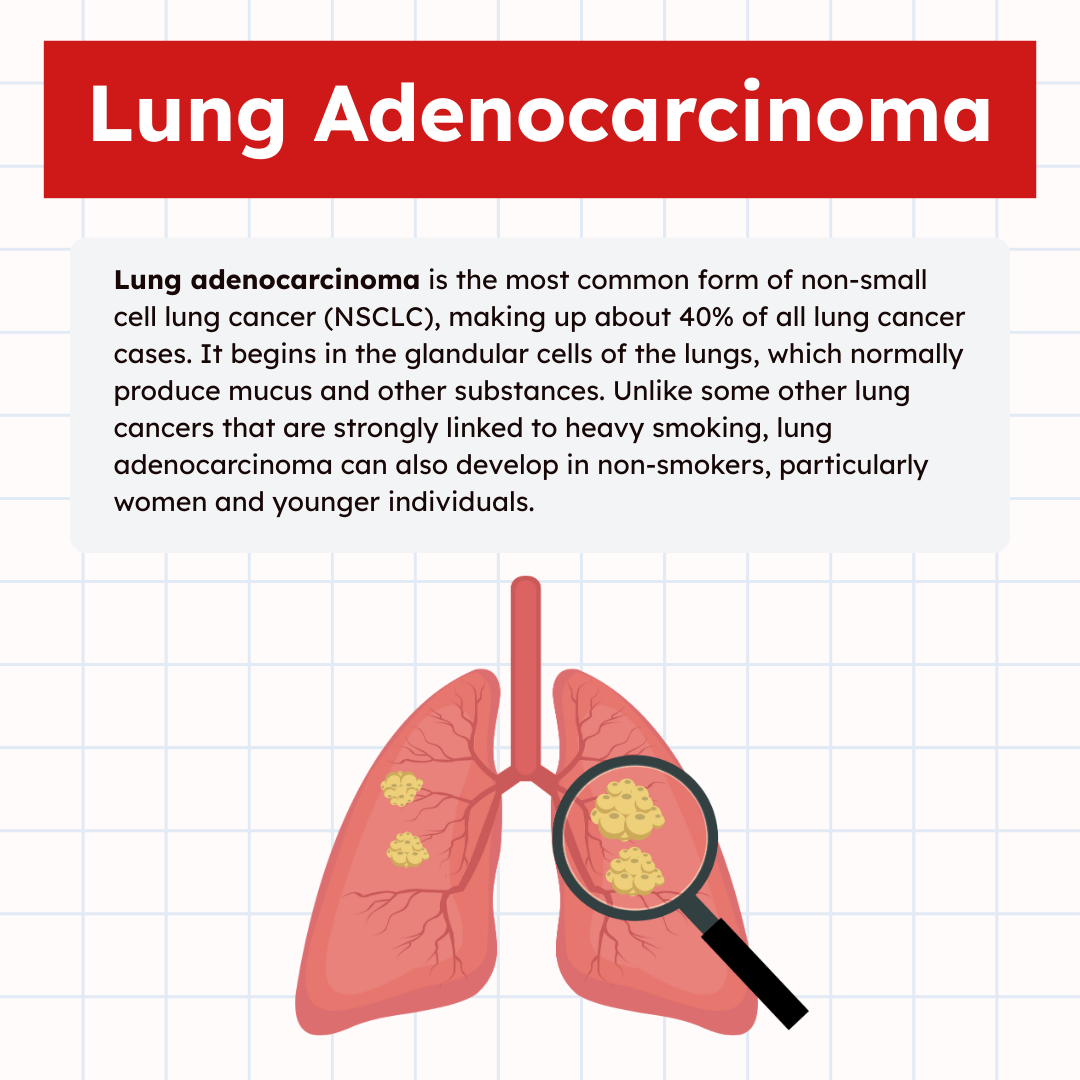 Lung adenocarcinoma causes types overview illustration infographic