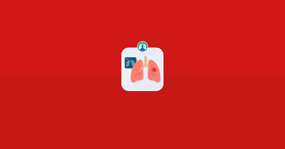 Lung adenocarcinoma vector