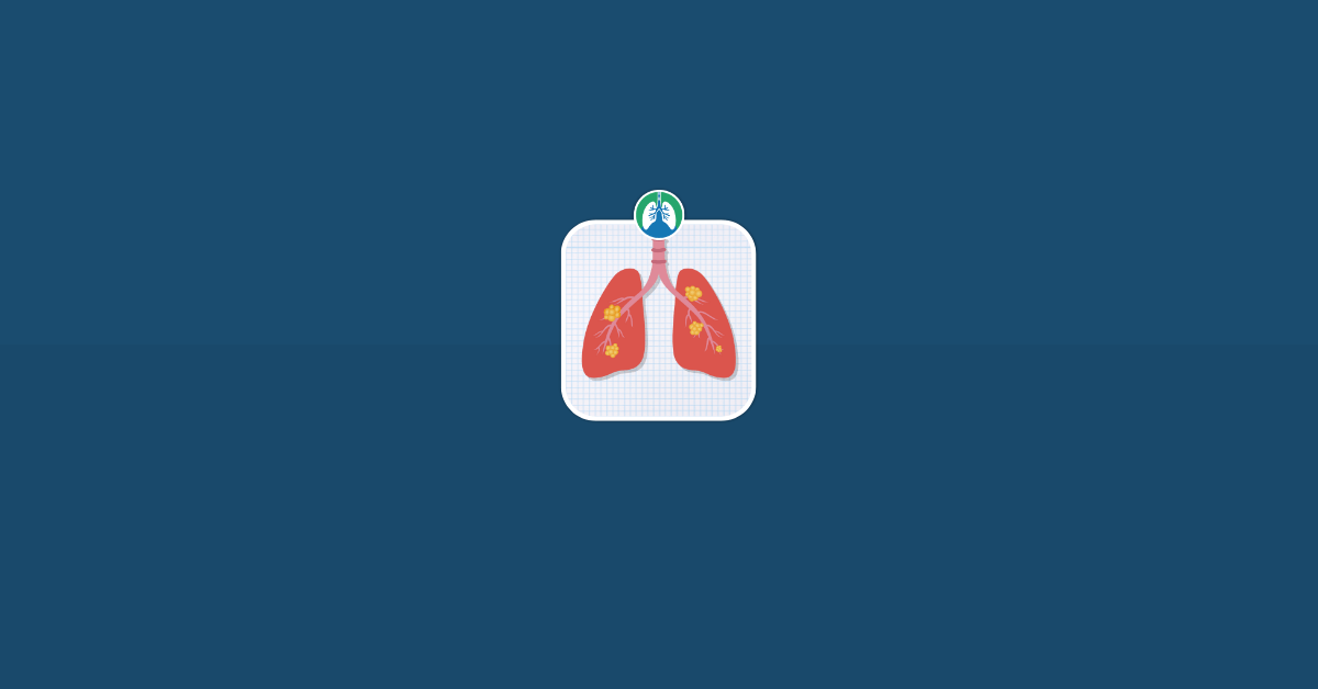 Most Common Sites of Metastasis of Lung Cancer Illustration Vector