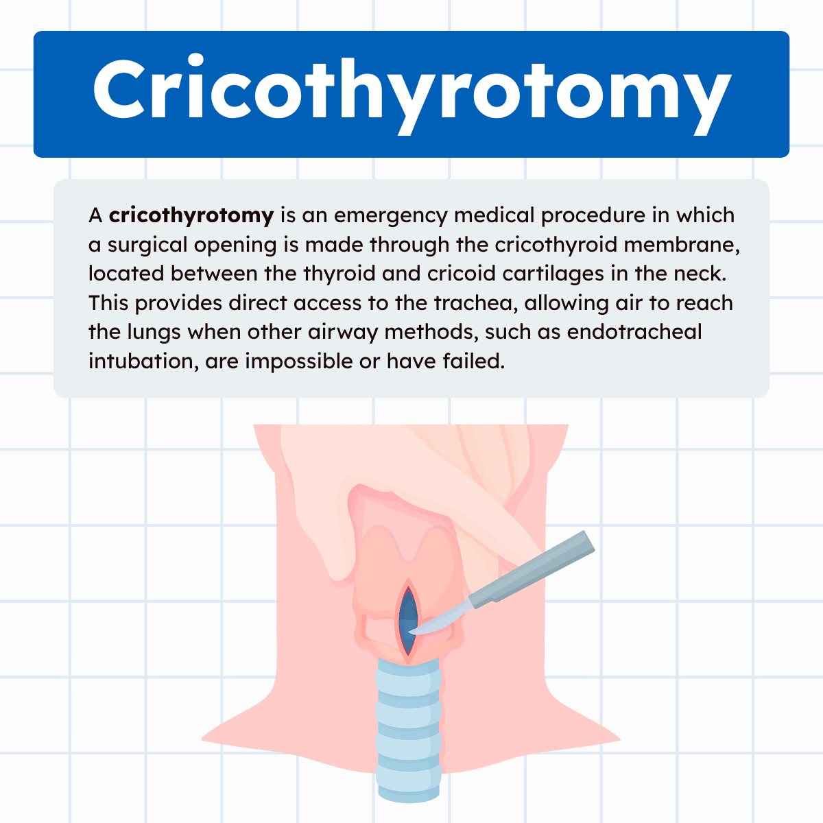 Cricothyrotomy Illustration Infographic