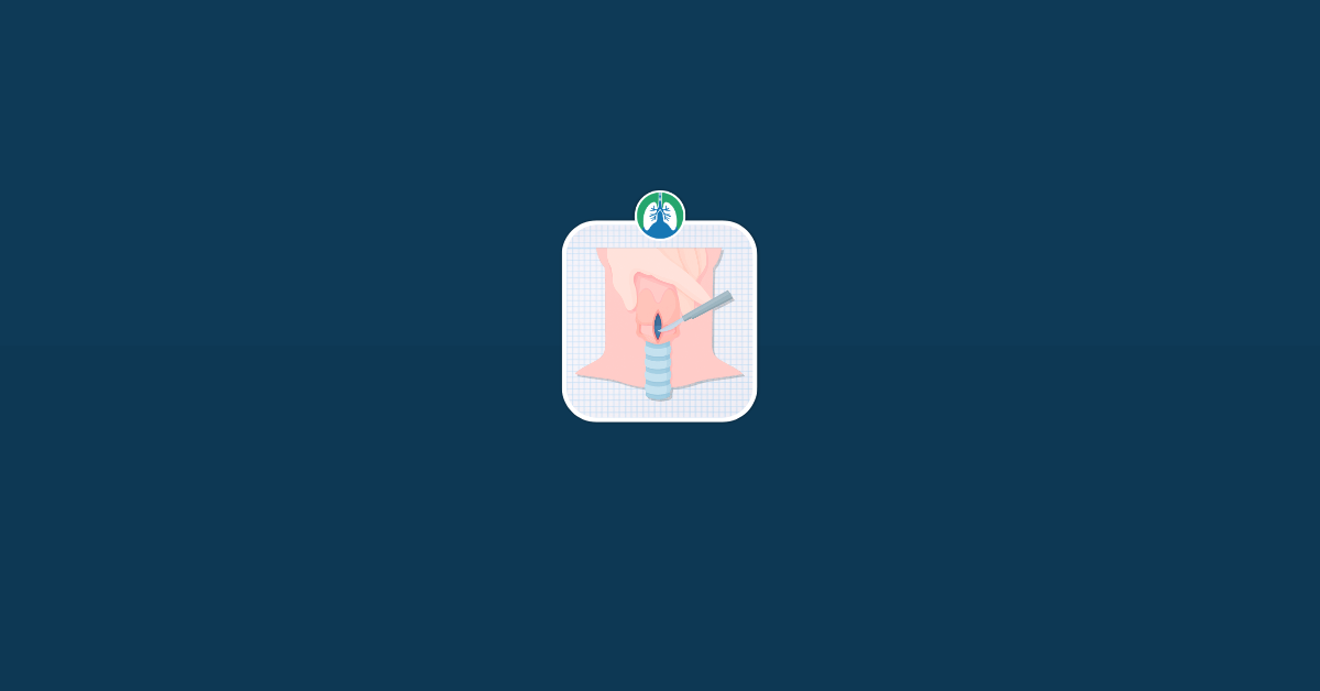 Cricothyrotomy vs Tracheostomy Illustration Vector