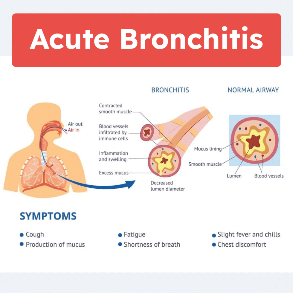 Acute Bronchitis: Overview and Practice Questions (2026)