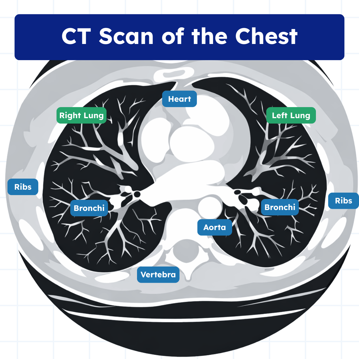 Computed Tomography (CT Scan) in Respiratory Care (2026)
