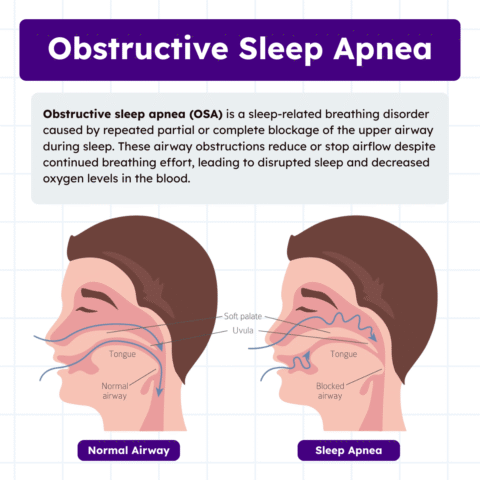 Obstructive Sleep Apnea: Overview and Practice Questions