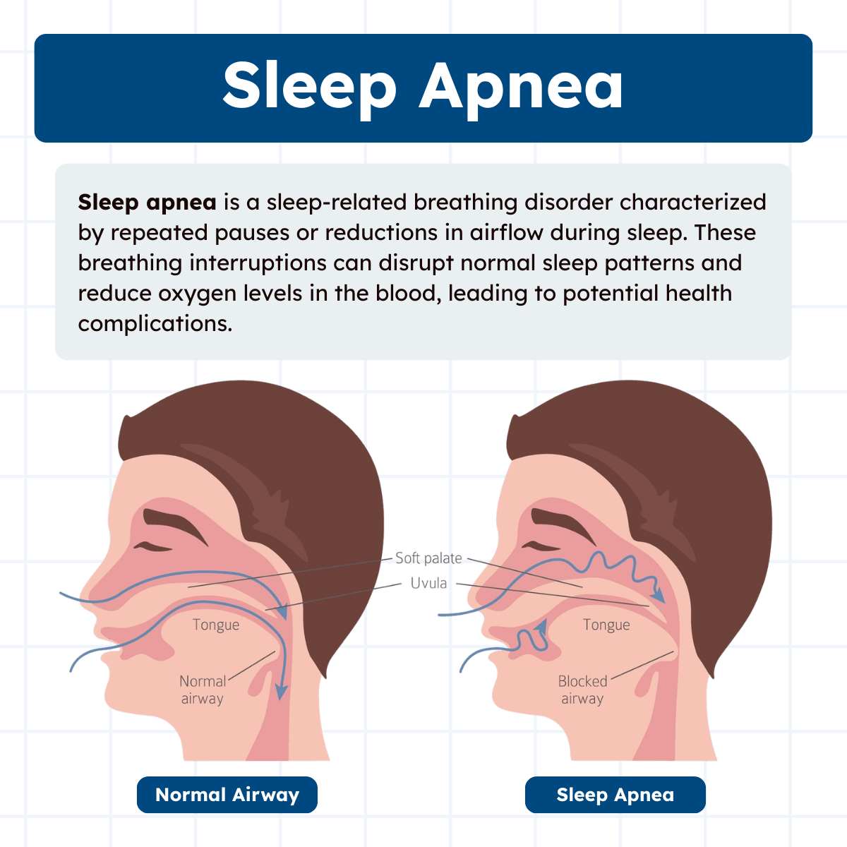 Sleep Apnea Illustration Infographic