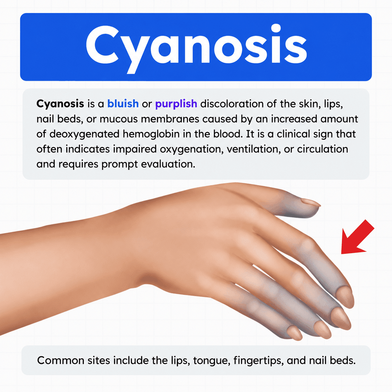 Cyantic Differential Cyanosis And Reverse Differential Cyanosis