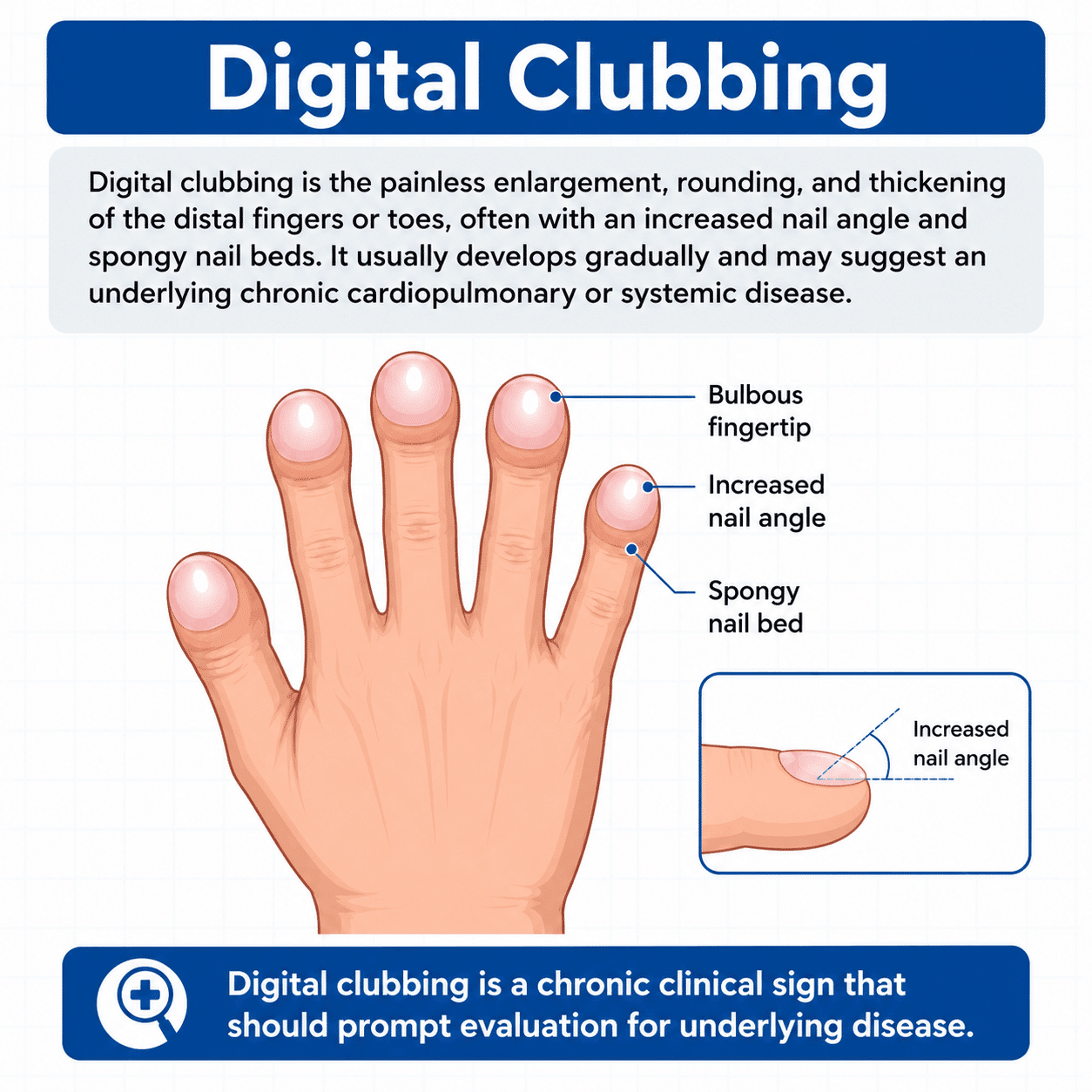 Digital Clubbing: Causes, Signs, and Clinical Meaning