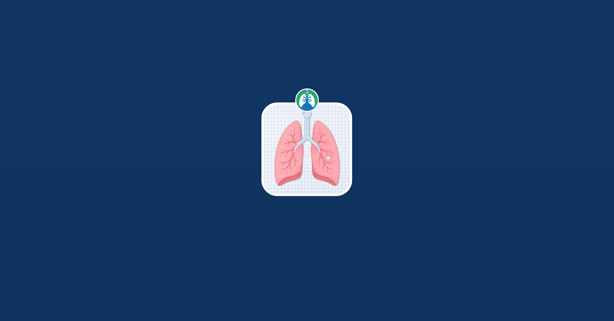 Can Lung Nodules Go Away on Their Own Vector Can Lung Nodules Go Away on Their Own Vector