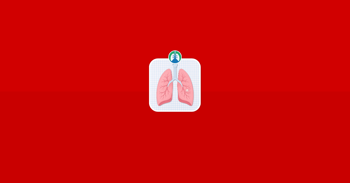 Ground Glass Lung Nodule- Causes, Risks, and Treatment Vector Ground Glass Lung Nodule- Causes, Risks, and Treatment Vector