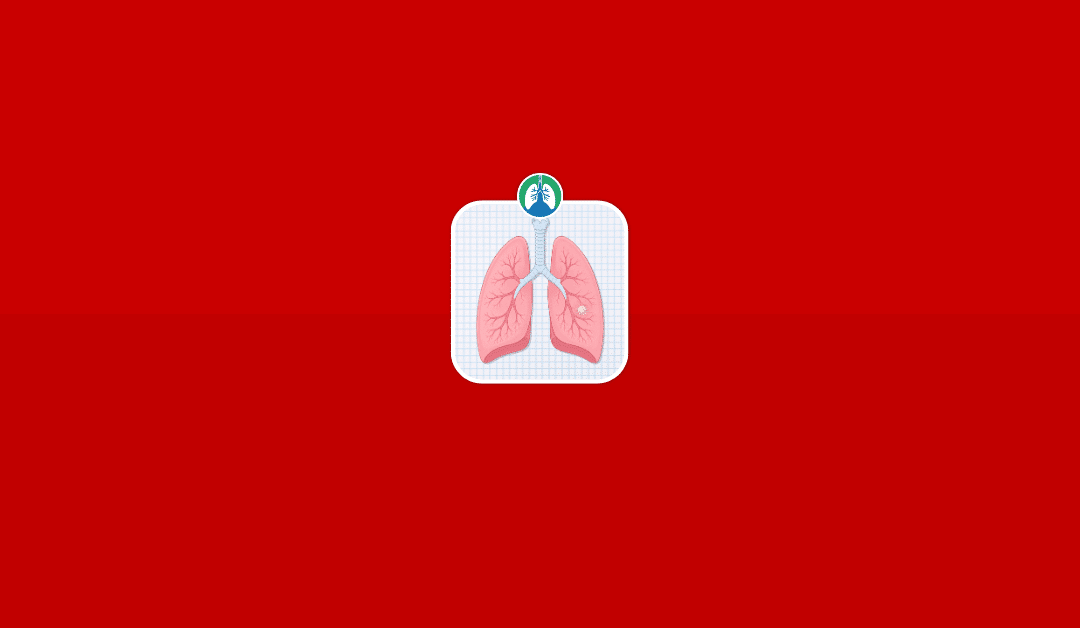 Is a Lung Nodule Always Cancer?