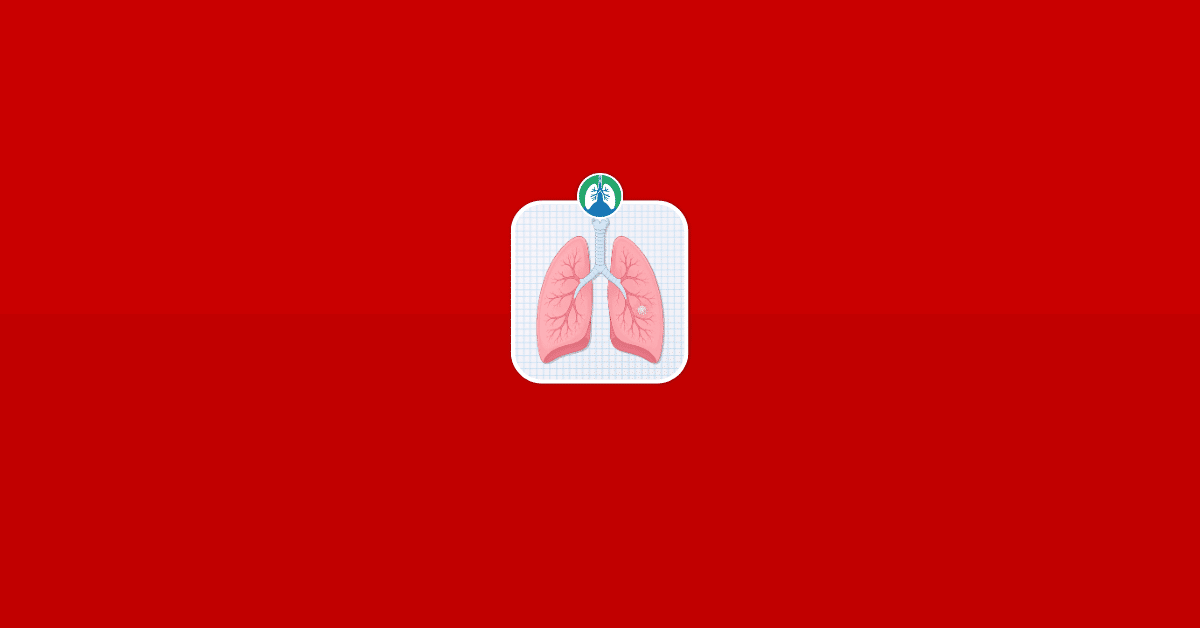 Is a Lung Nodule Always Cancer Illustration Vector Is a Lung Nodule Always Cancer Illustration Vector