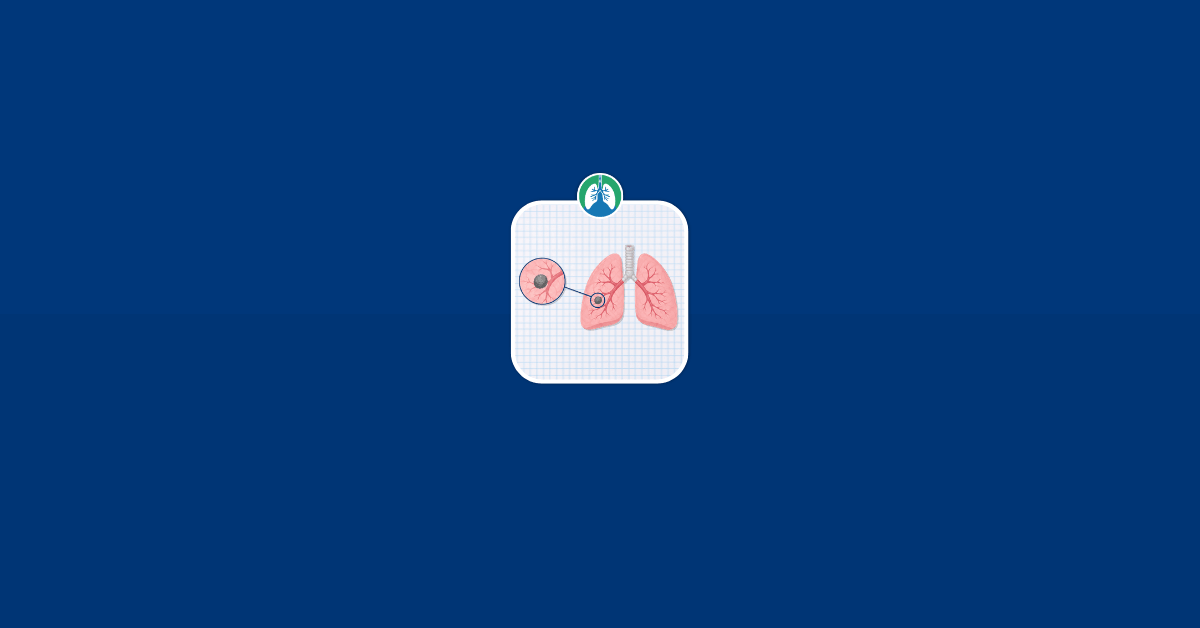Lung Nodule Image Illustration Vector Lung Nodule Image Illustration Vector