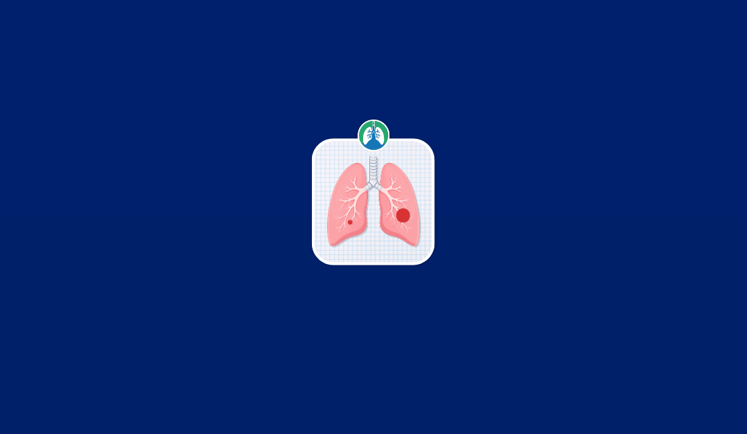 Lung Mass vs. Nodule: Differences, Causes, and Cancer Risk