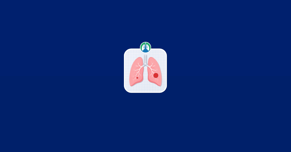 Lung Mass vs. Nodule Illustration Vector Lung Mass vs. Nodule Illustration Vector